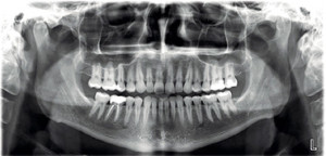 Panoramic xray